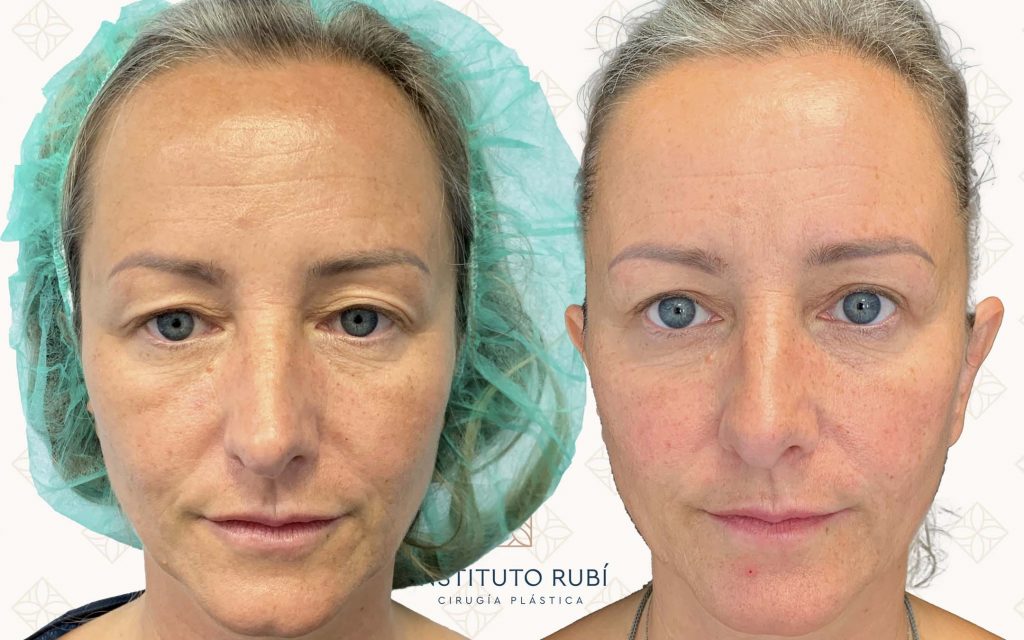 Comparación Blefaroplastia Frente blefaroplastia almeria