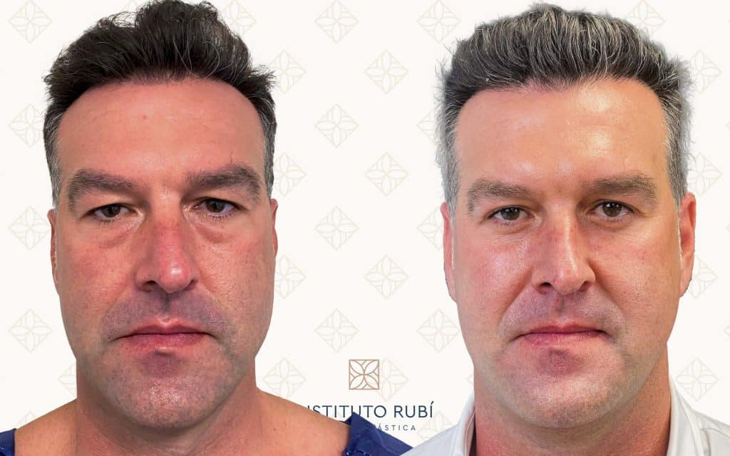 Comparación Blefaroplastia Frente-2 blefaroplastia almeria