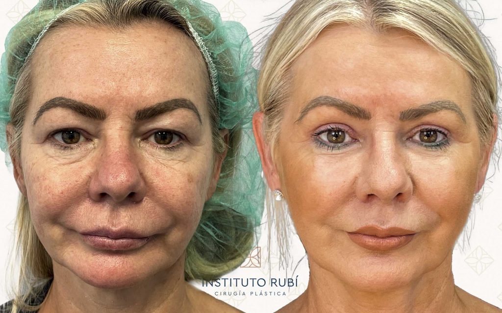 Comparación Blefaroplastia Frente-3 blefaroplastia mallorca