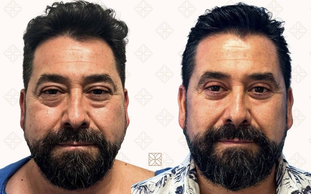 Comparación Blefaroplastia Frente-4 blefaroplastia mallorca