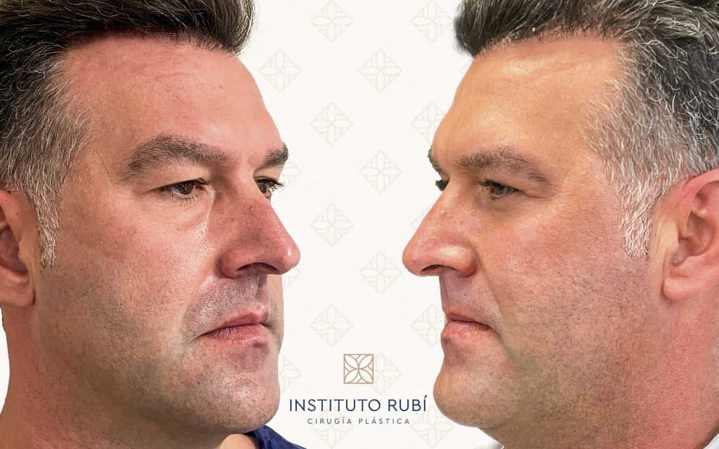 Comparación Blefaroplastia Lado-2 blefaroplastia canarias