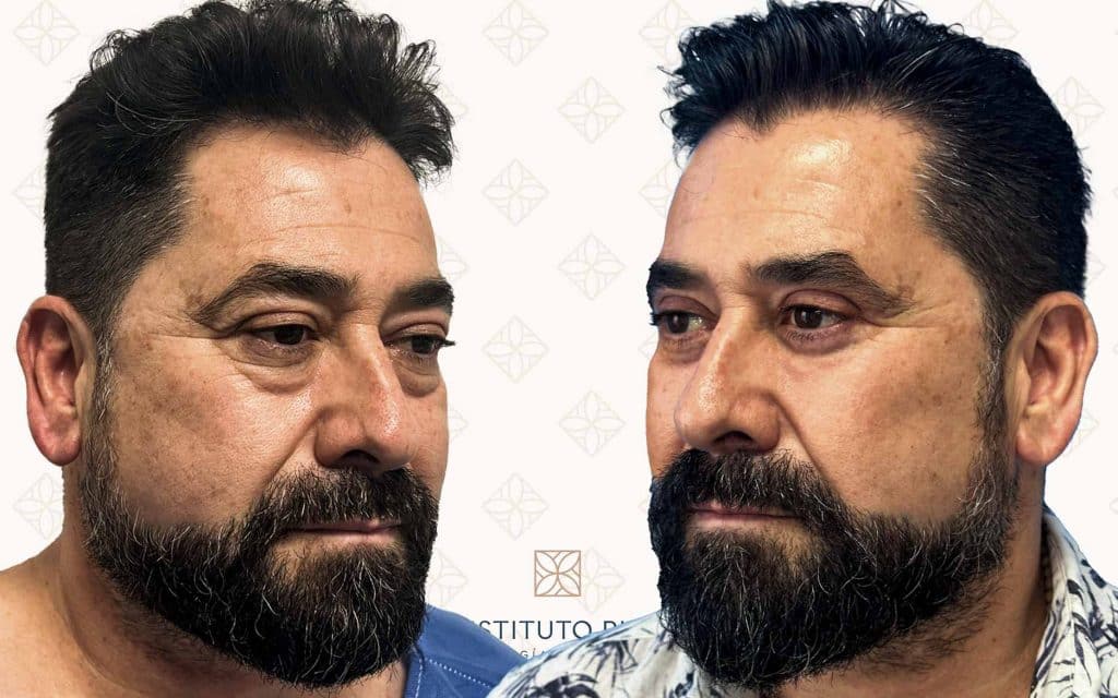 Comparación Blefaroplastia Lado-4 blefaroplastia barcelona
