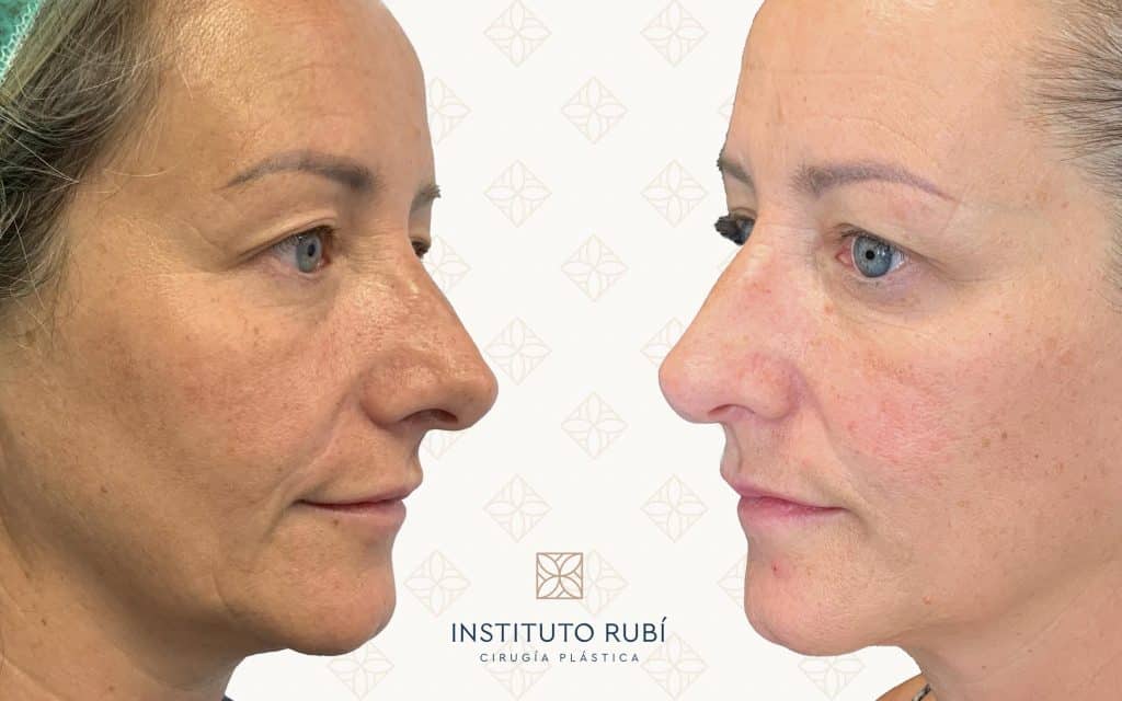 Comparación Blefaroplastia lado blefaroplastia canarias