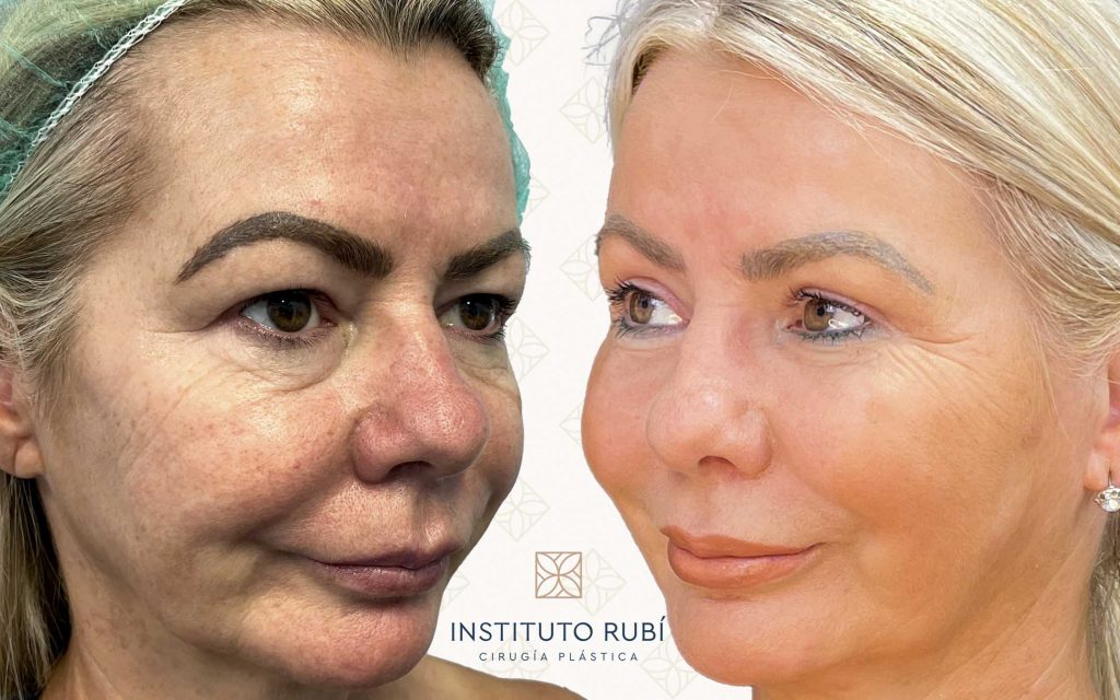 Comparación Blefaroplastia lado-3 blefaroplastia madrid