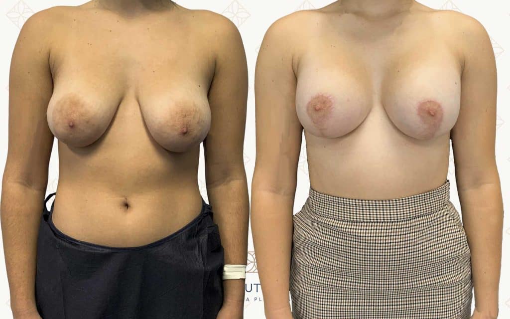 Comparación Frente-2 mastopexia mallorca