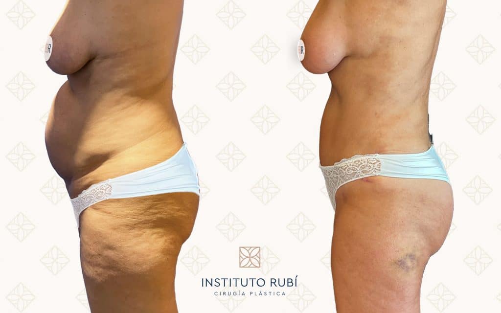 Comparaciones Perfil lipoescultura almeria