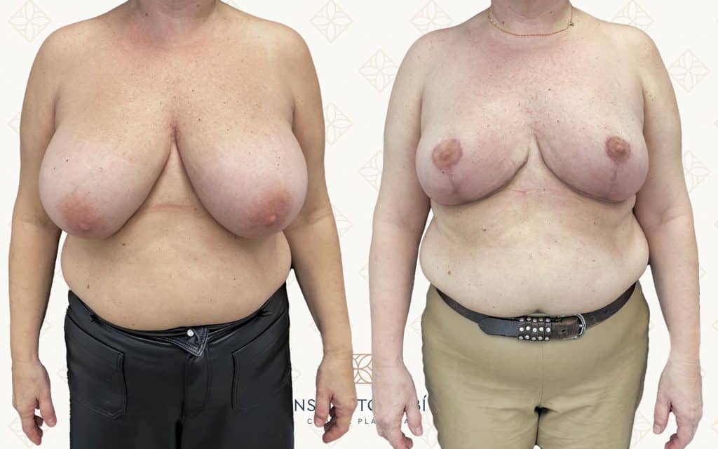 Comparación Frente-2 reduccion de pecho barcelona