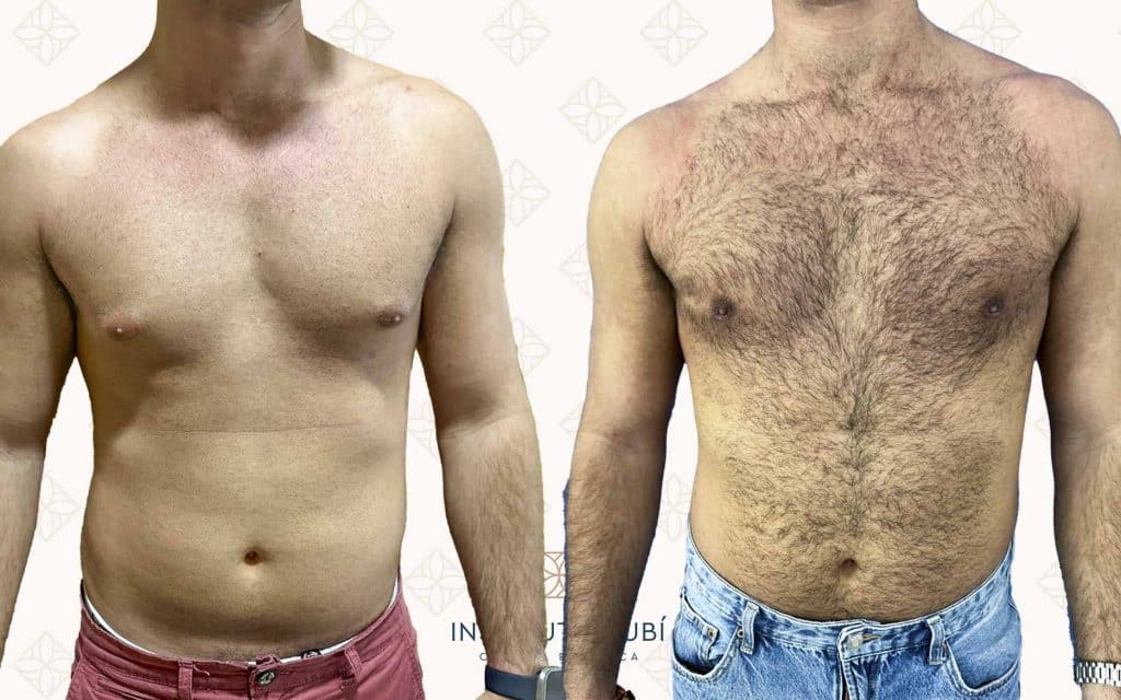 Comparación Frente-2 ginecomastia almeria