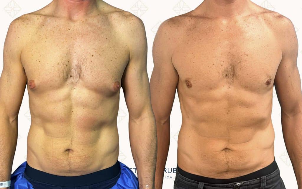 Comparación Frente ginecomastia almeria