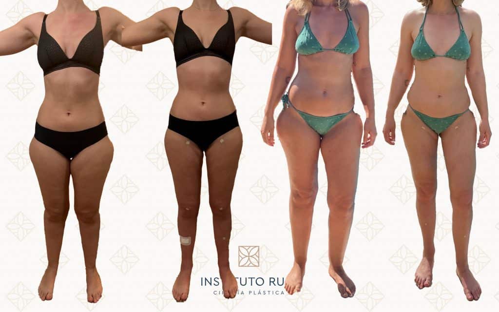 Comparación Frente lipedema canarias