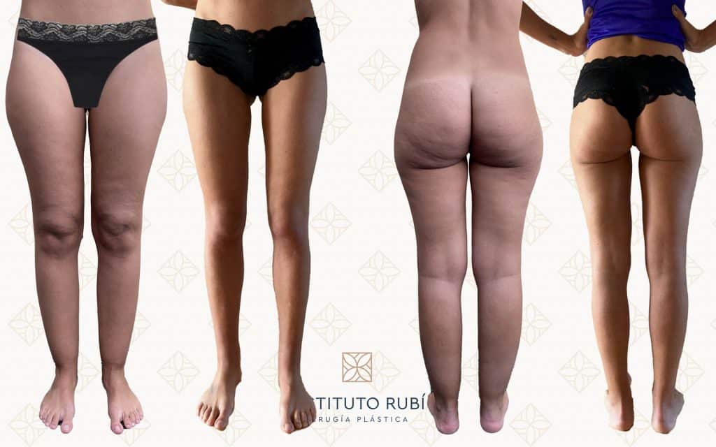 Comparación Frente y atrás lipedema canarias