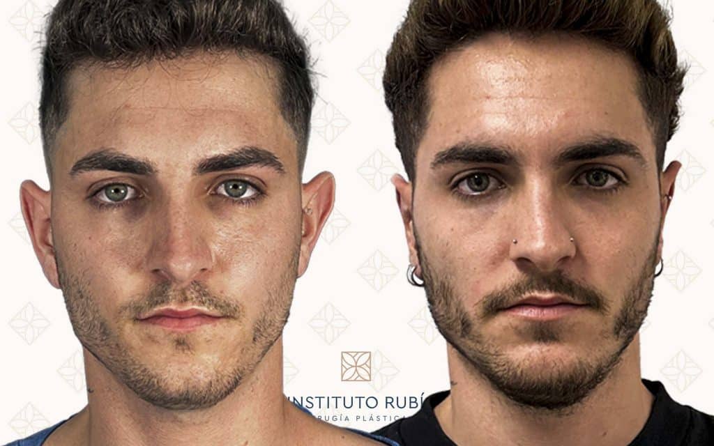 Comparación frente-3 otoplastia barcelona