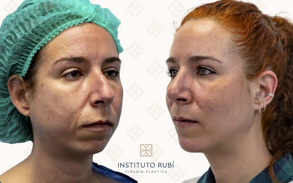 Comparación lado mentoplastia canarias