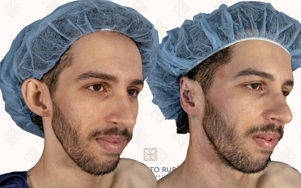Comparación lado otoplastia mallorca