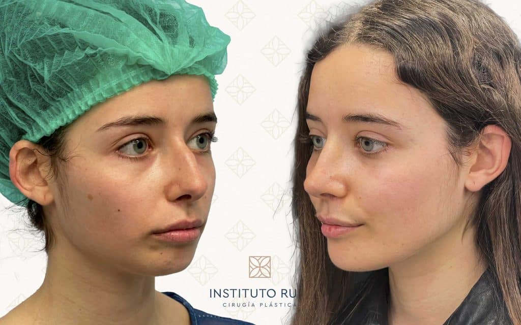 Comparación lado-2 mentoplastia barcelona