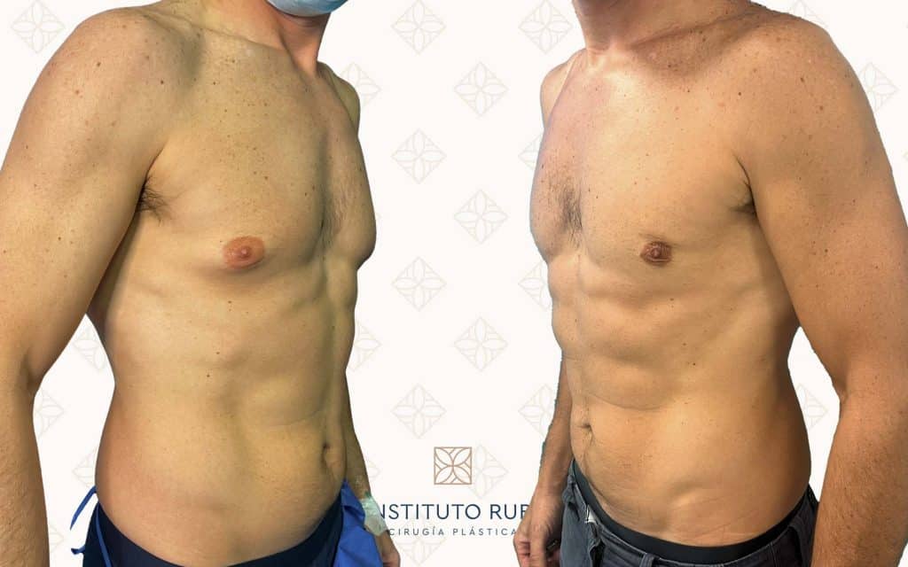 Comparación lado ginecomastia mallorca