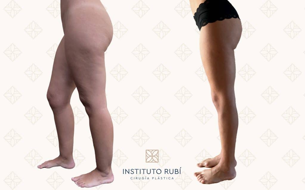 Comparación lado lipedema almeria
