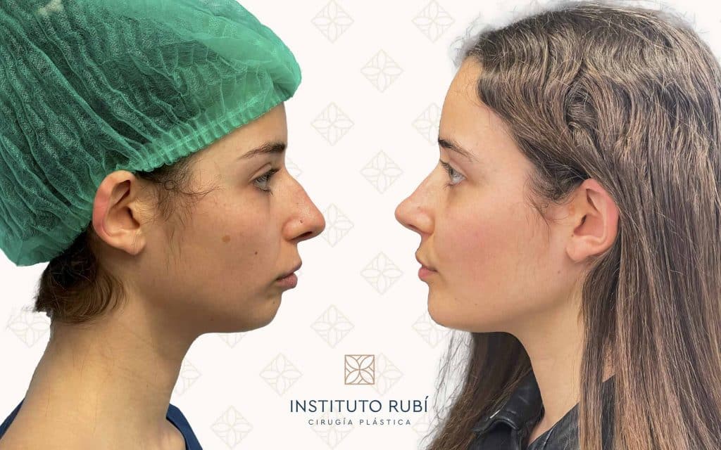 Comparación perfil mentoplastia almeria