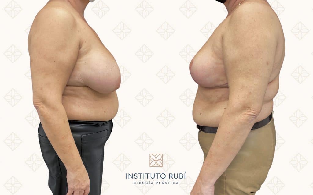 Comparación perfil-2 reduccion de pecho almeria