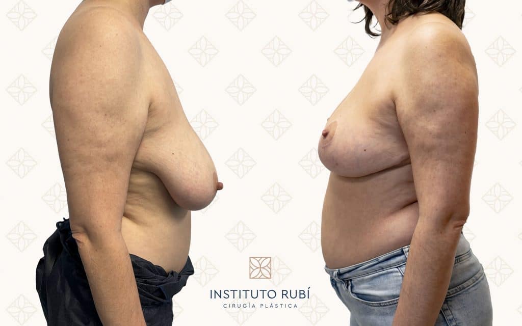 Comparación perfil reduccion de pecho madrid