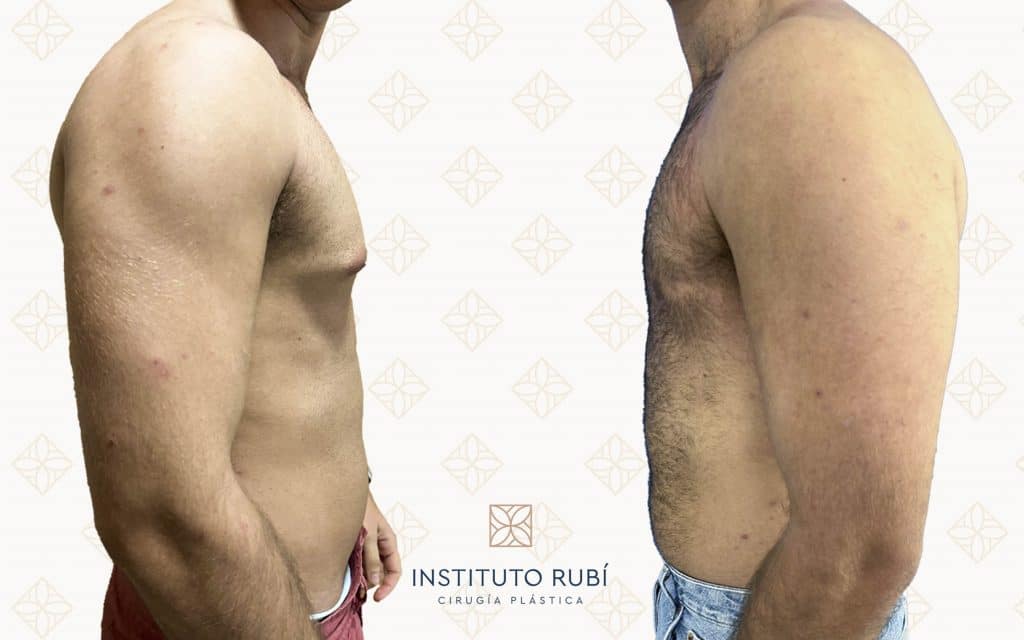 Comparación perfil ginecomastia mallorca