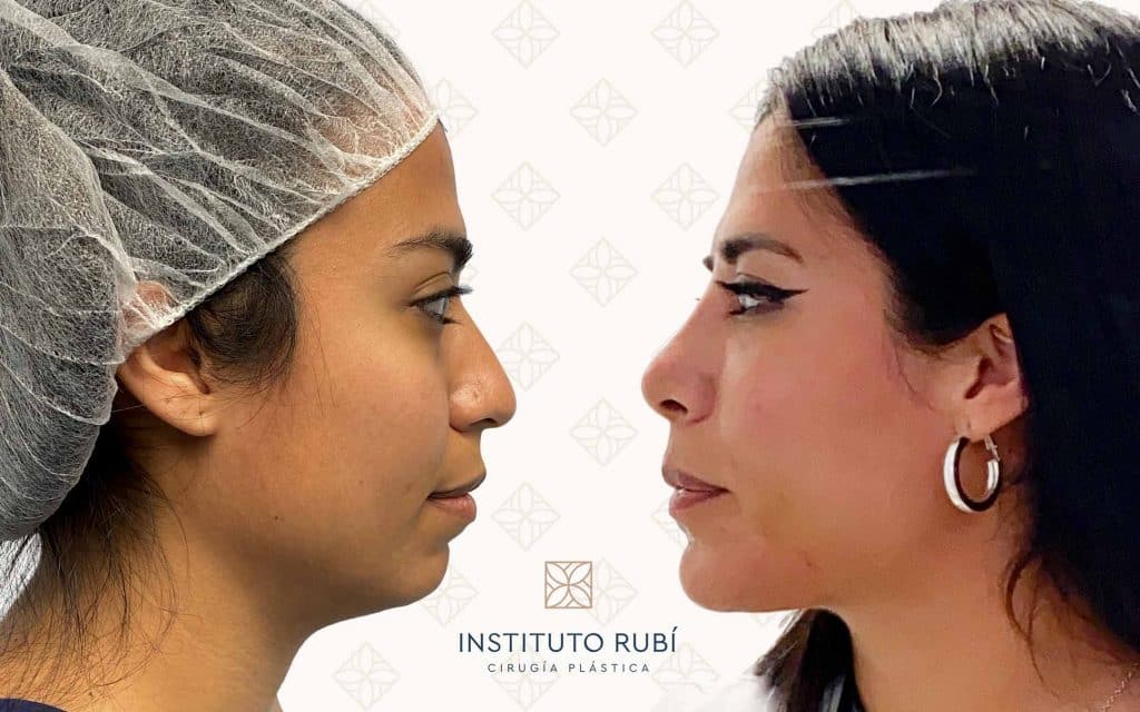 Comparaciones mentoplastia madrid