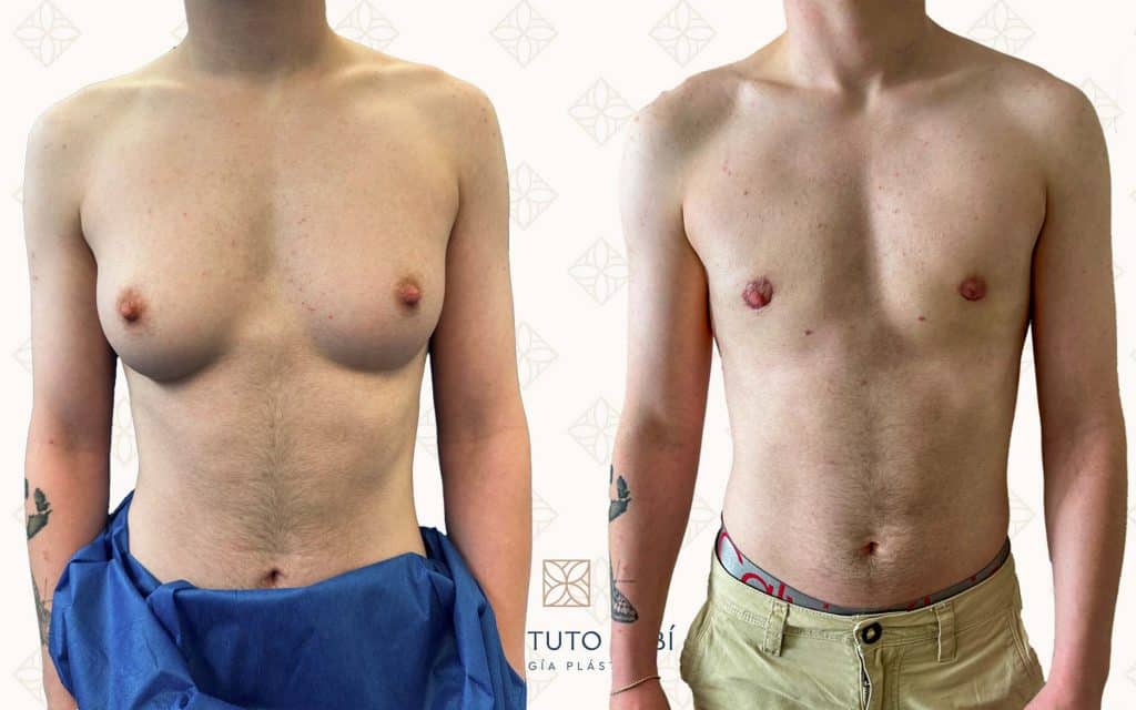 Frente mastectomia trans mallorca