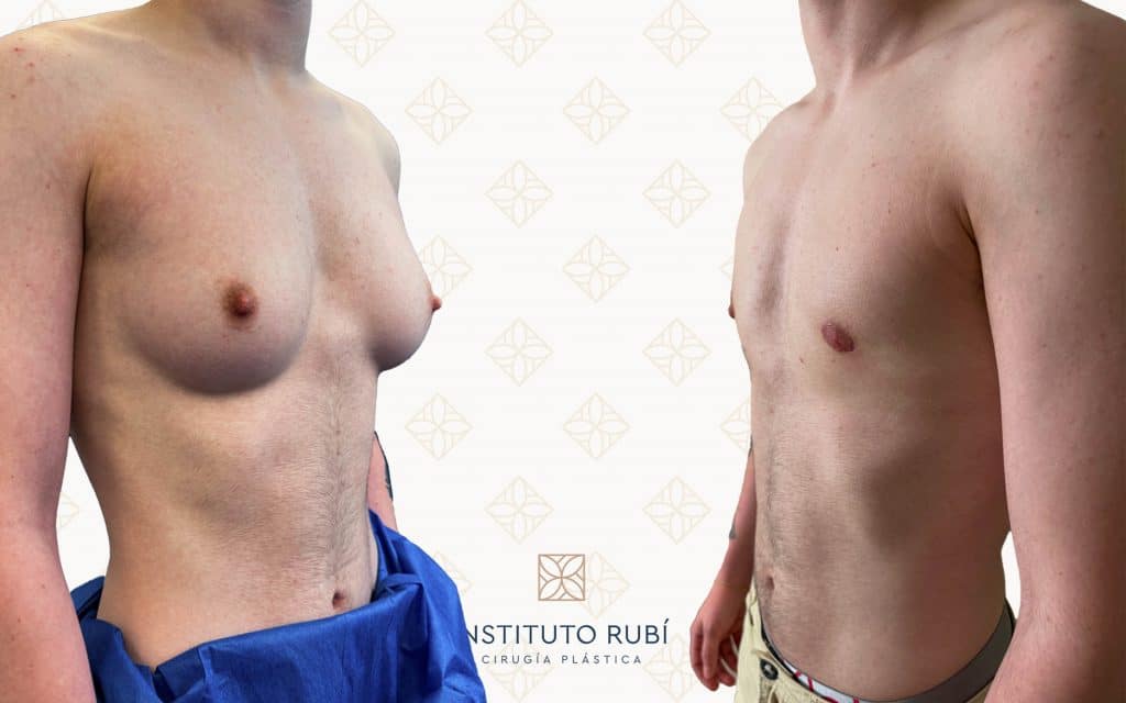 Lado mastectomia trans barcelona