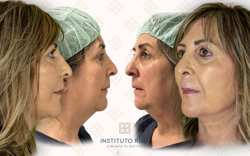 Lado y perfil lifting canarias