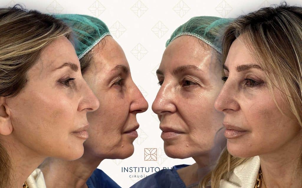 Lado y perfil-2 lifting madrid