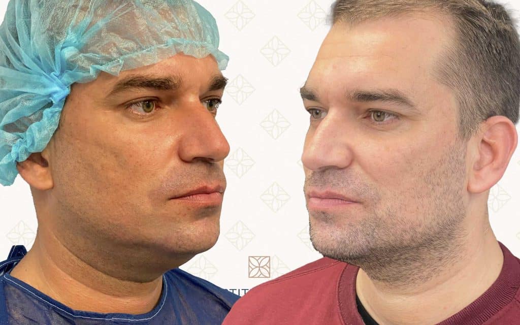 Lipo de papada Lado liposuccion de papada canarias