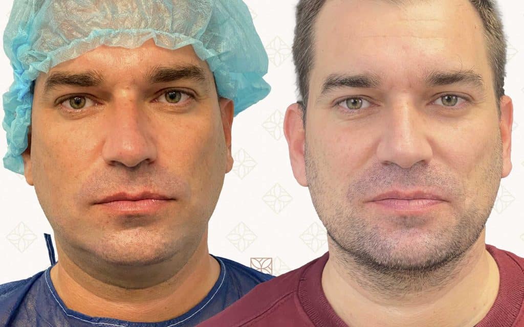 Lipo de papada frente liposuccion de papada madrid