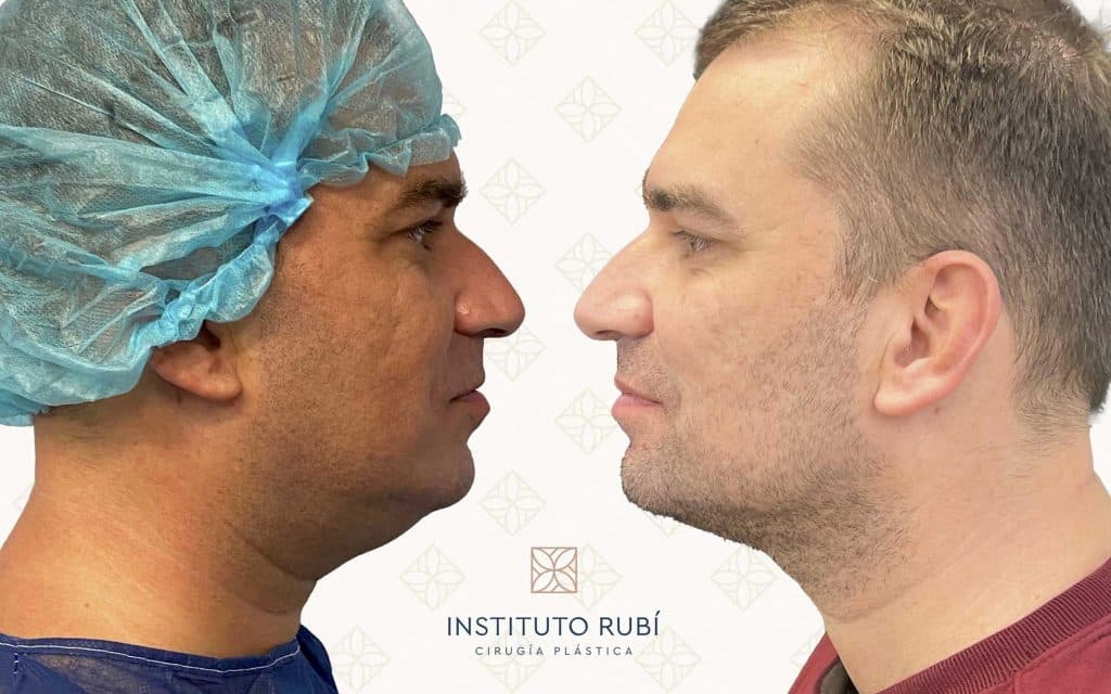 Lipo de papada perfil liposuccion de papada barcelona