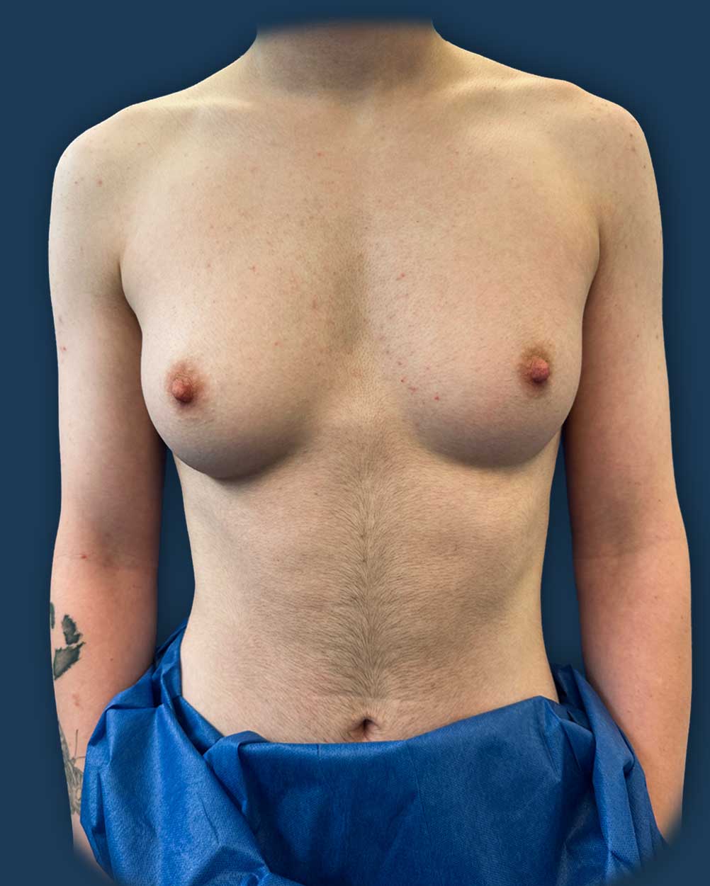 mastectomia trans madrid