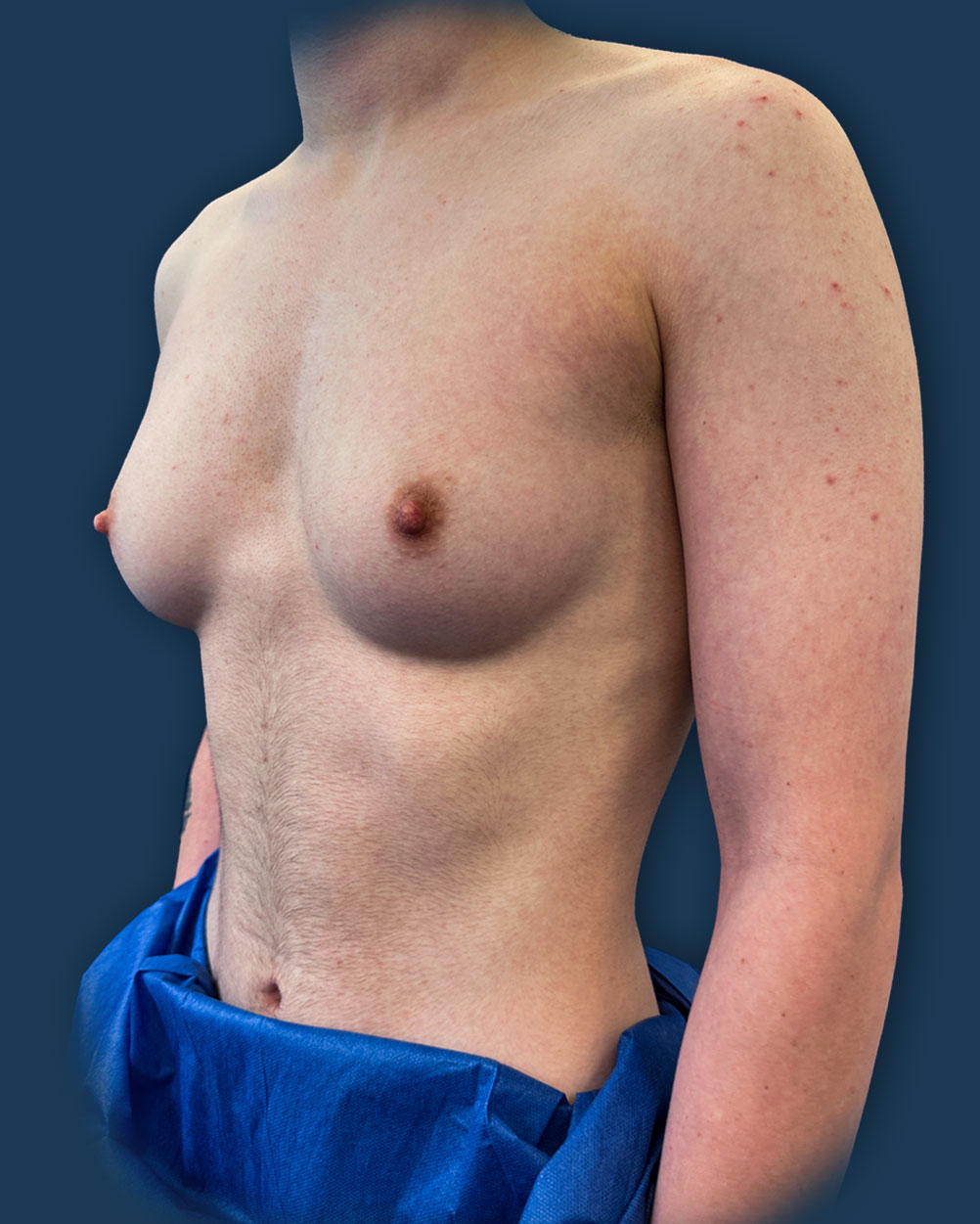 mastectomia trans almeria