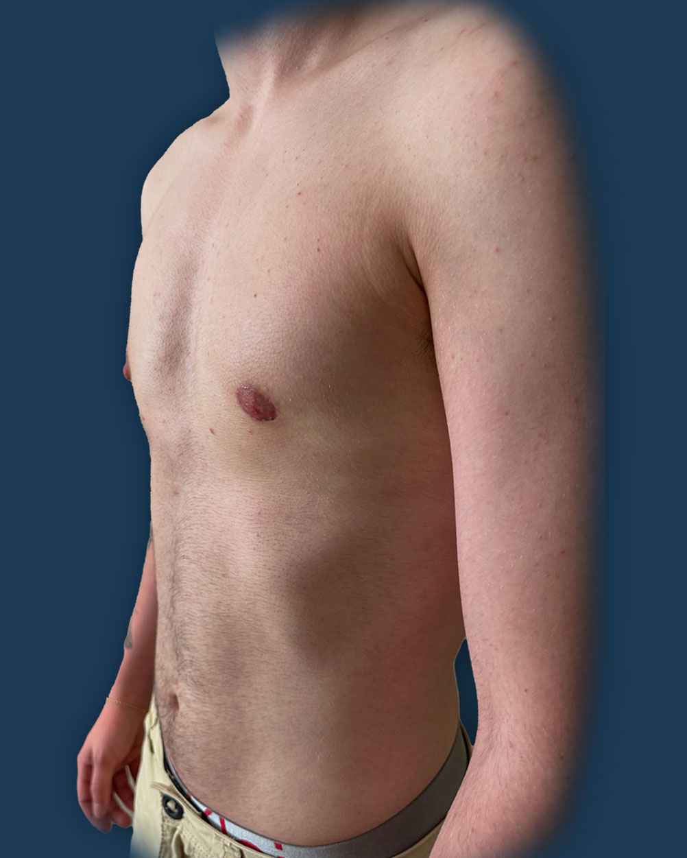 mastectomia trans madrid