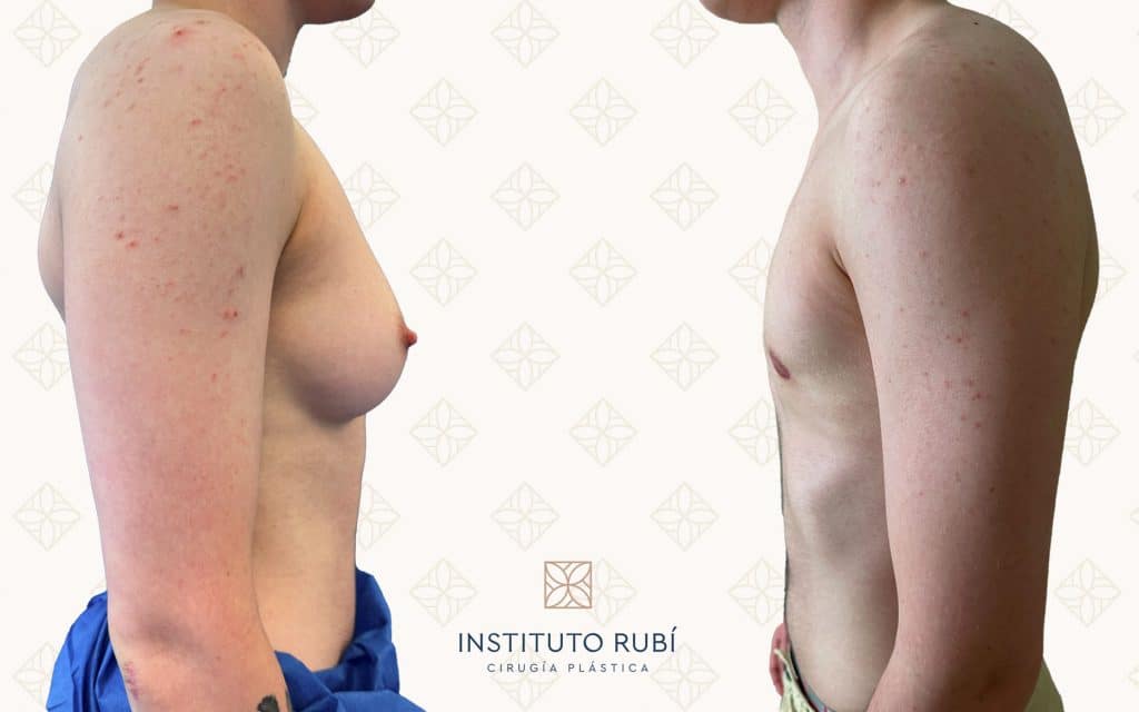 Perfil mastectomia trans bacelona