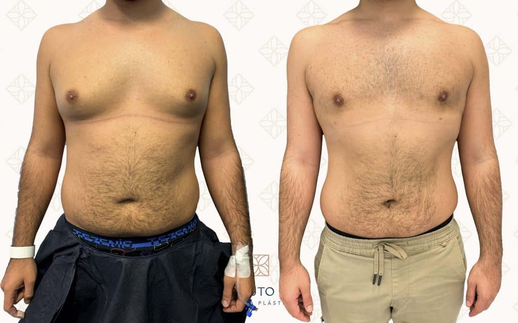 cirugia de ginecomastia1 ginecomastia barcelona