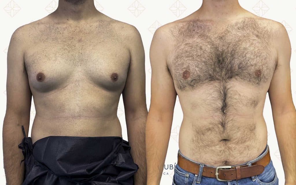 cirugia de ginecomastia2 ginecomastia barcelona