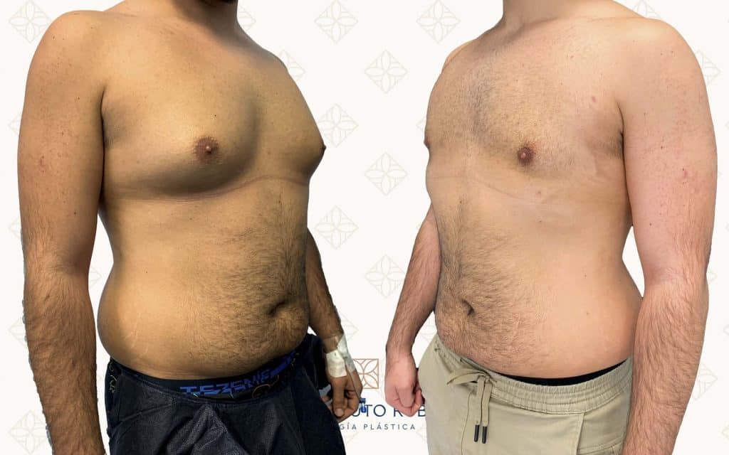 cirugia de ginecomastia3 ginecomastia madrid