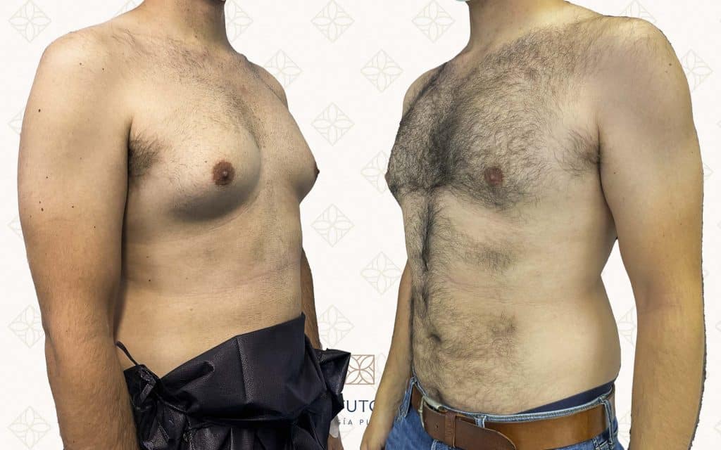 cirugia de ginecomastia4 ginecomastia madrid