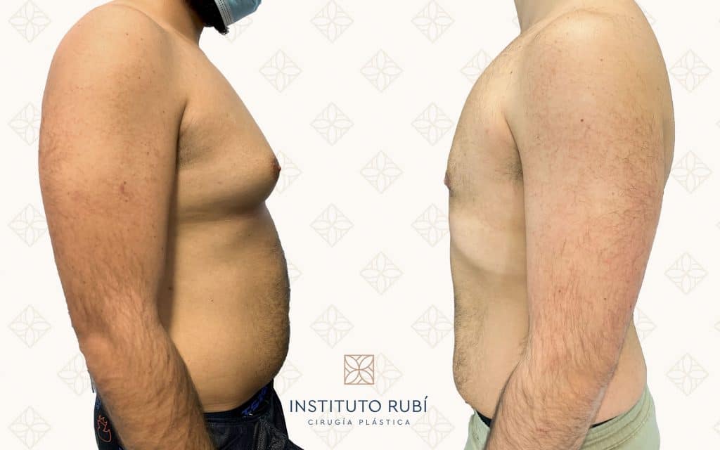 cirugia de ginecomastia5 ginecomastia canarias