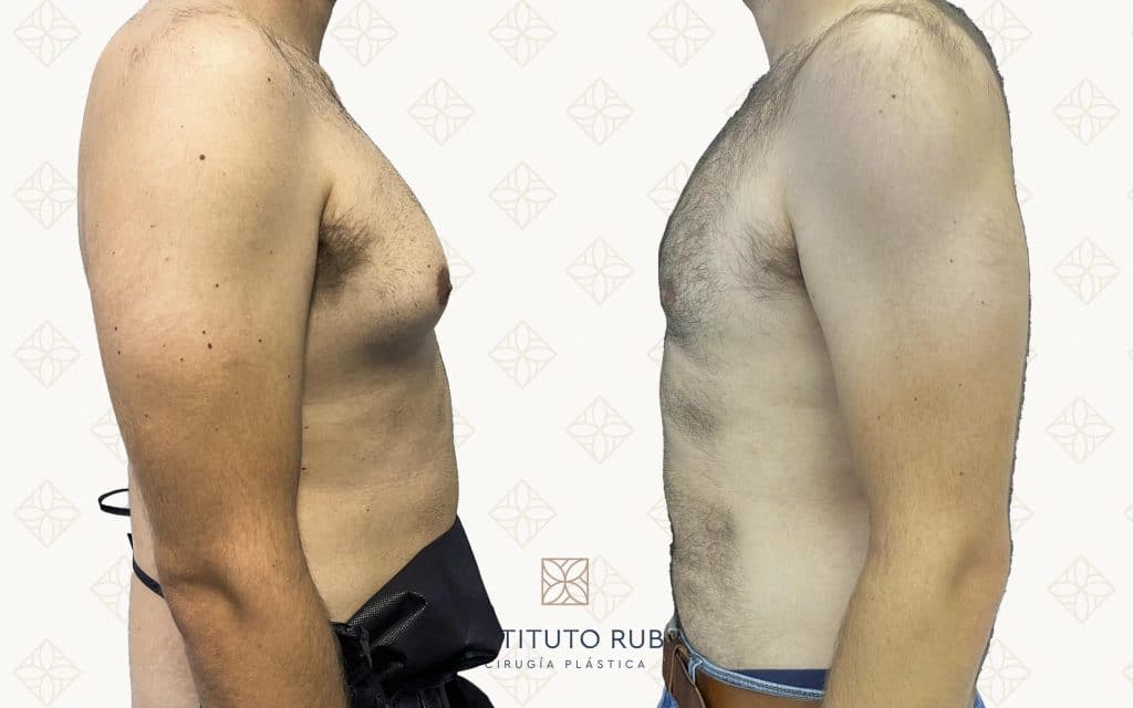cirugia de ginecomastia6 ginecomastia canarias