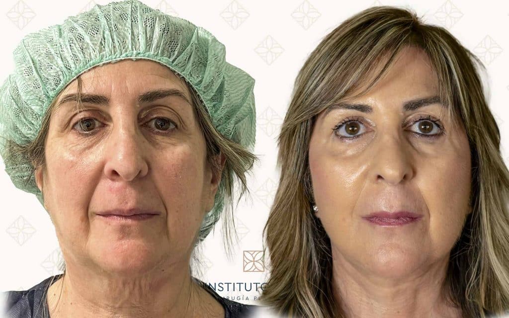 frente lifting madrid