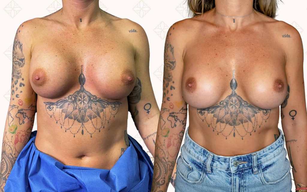 frente-2 recambio de protesis barcelona