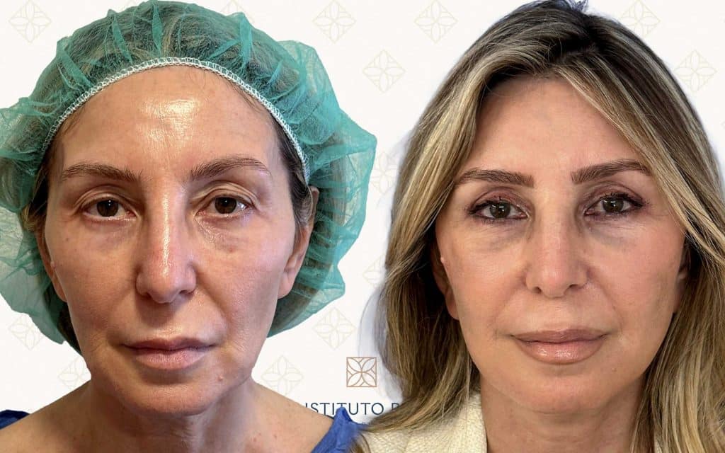 frente-2 lifting barcelona