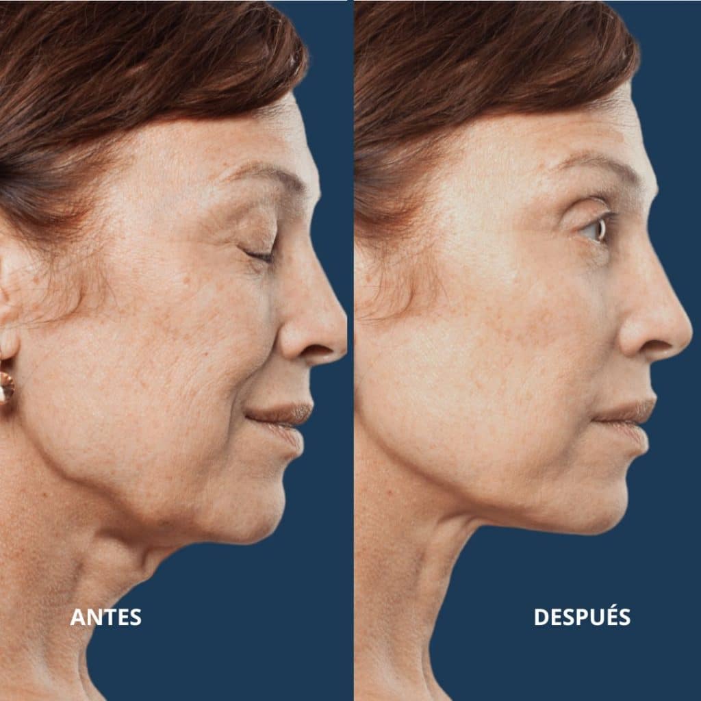 antes y despues lifting facial resultado de lifting facial en mujer de perfil, antes y después con mejora notable en cuello, mandíbula y firmeza de la piel