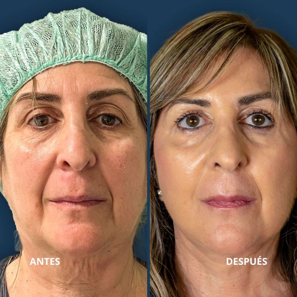 ANTES (23) antes y después de lifting facial en mujer, mejora visible en firmeza de la piel, contorno facial más definido y reducción de arrugas