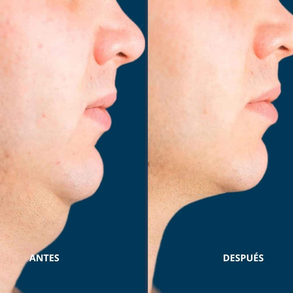lipo de papada antes y despues eliminar papada antes y después de una liposucción de papada en hombre, perfil facial con reducción de grasa submentoniana