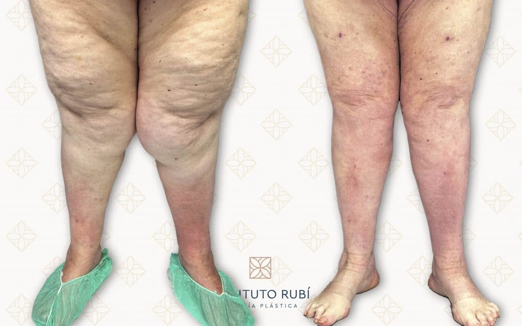 Comparación Frente-2 antes y después de lipedema en piernas, reducción de volumen y mejora del contorno tras cirugía plástica